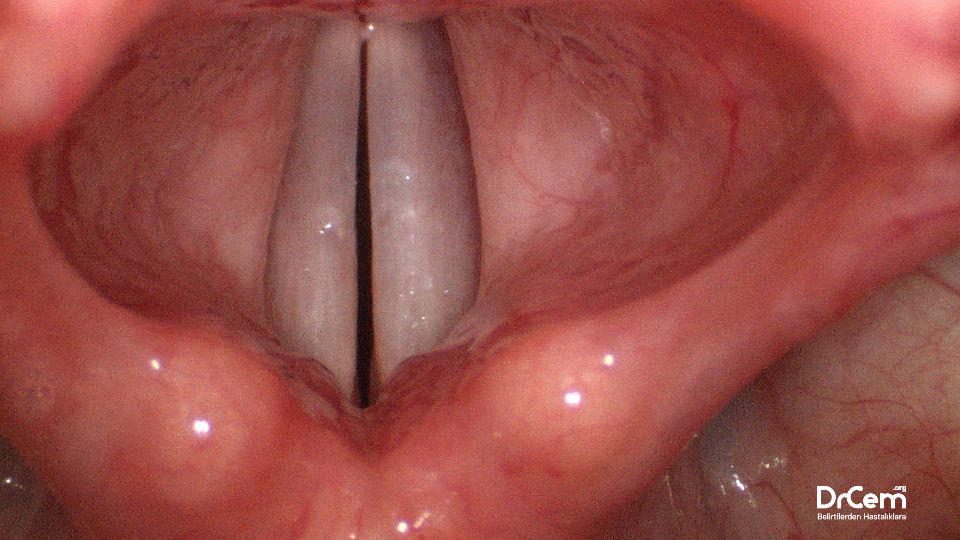Vokal Nodül görseli - DrCem hastalık rehberi